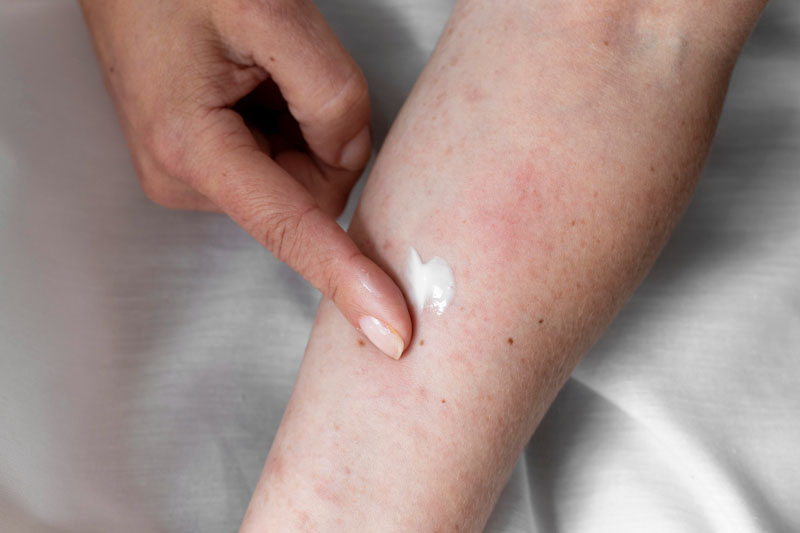  eczema ojos